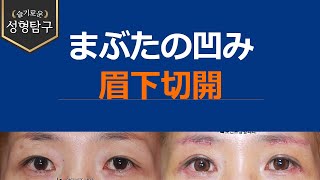 【韓国二重整形】まぶたのくぼみ解消、眉下リフト(眉下切開)の症例