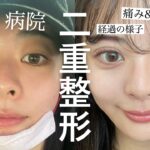 【二重整形】念願の埋没しました。ダウンタイム全て公開します👁♡