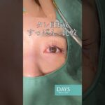 【目元整形】すっぴんカラコンなしで比較してみました！#shorts